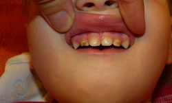 Гипоплазия зубов