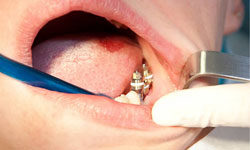 Имплантация зубов и ее неприятные последствия