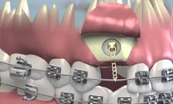 Имплантация зубов и ортодонтия