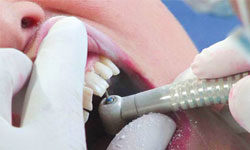 При каких повреждениях можно реставрировать зуб