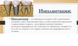 Словарь терминов по имплантации зубов